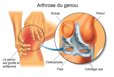 L'association de la spiruline du ginkgo biloba et de la myrtille régénère le cartilage rapidement